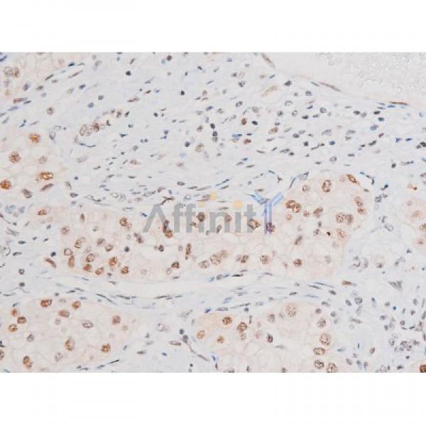 Phospho-NF-kB p65 (Ser281) Antibody - AF3393 at 1/200 staining Human kidney cancer tissue sections by IHC-P.